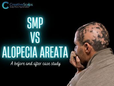 SMP-Vs-Alopecia-Areata Cover photo